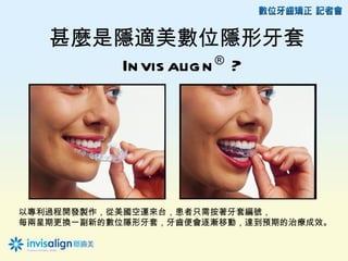 甚麼是隱適美數位隱形牙套
      In vis alig n ® ?




以專利過程開發製作，從美國空運來台，患者只需按著牙套編號，
每兩星期更換一副新的數位隱形牙套，牙齒便會逐漸移動，達到預期的治療成效。
 