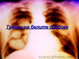 Тумори на белите дробове
 