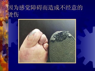 因为感觉障碍而造成不经意的
烫伤
 
