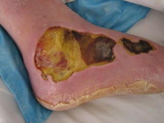 国际奥比斯糖尿病视网膜病变防治讲座（糖尿病教育、糖尿病足）