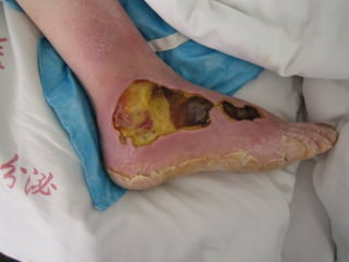 国际奥比斯糖尿病视网膜病变防治讲座（糖尿病教育、糖尿病足）