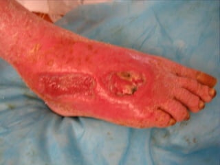 国际奥比斯糖尿病视网膜病变防治讲座（糖尿病教育、糖尿病足）