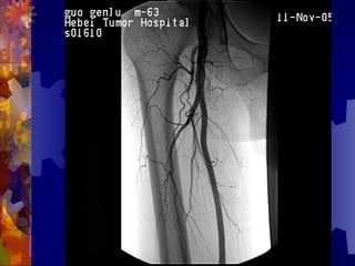 国际奥比斯糖尿病视网膜病变防治讲座（糖尿病教育、糖尿病足）