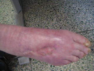 国际奥比斯糖尿病视网膜病变防治讲座（糖尿病教育、糖尿病足）