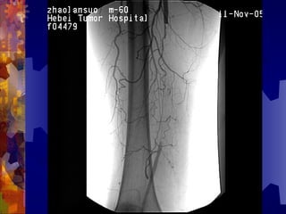 国际奥比斯糖尿病视网膜病变防治讲座（糖尿病教育、糖尿病足）