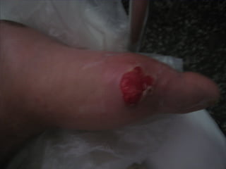 国际奥比斯糖尿病视网膜病变防治讲座（糖尿病教育、糖尿病足）