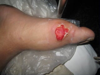 国际奥比斯糖尿病视网膜病变防治讲座（糖尿病教育、糖尿病足）