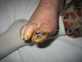 国际奥比斯糖尿病视网膜病变防治讲座（糖尿病教育、糖尿病足）