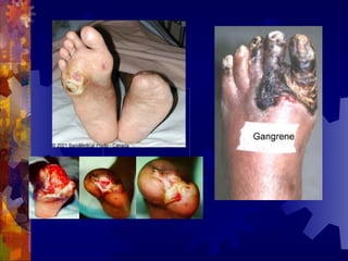 坏死和截肢
 