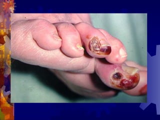 下肢缺血引起的溃疡、坏死
 