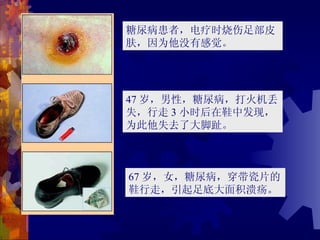 糖尿病患者，电疗时烧伤足部皮
肤，因为他没有感觉。




47 岁，男性，糖尿病，打火机丢
失，行走 3 小时后在鞋中发现，
为此他失去了大脚趾。



67 岁，女，糖尿病，穿带瓷片的
鞋行走，引起足底大面积溃疡。
 