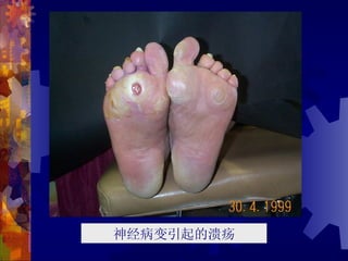 神经病变引起的溃疡
 