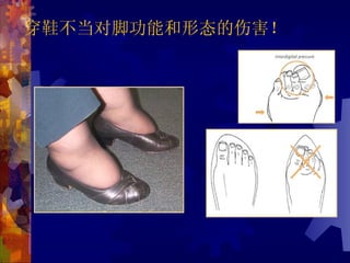 穿鞋不当对脚功能和形态的伤害！
 