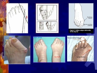 拇外翻
 
