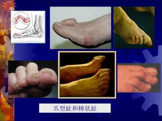 爪型趾和棰状趾
 