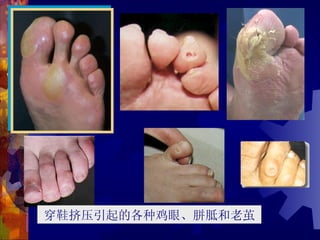 穿鞋挤压引起的各种鸡眼、胼胝和老茧
 