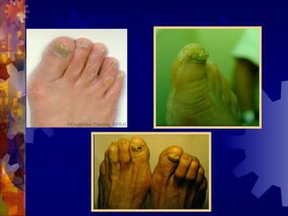 霉菌感染（灰指甲）
 