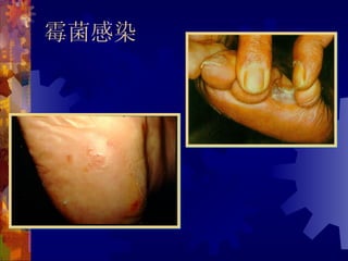 霉菌感染
 