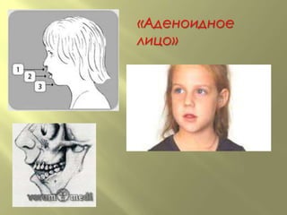 «Аденоидное
лицо»
 