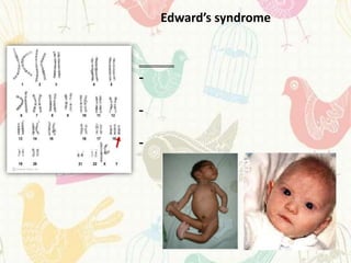 Edward’s syndrome



-

-

-
 