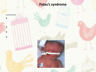 Patau’s syndrome


•

•
•
•
 