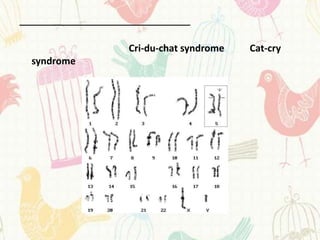 Cri-du-chat syndrome   Cat-cry
syndrome
 