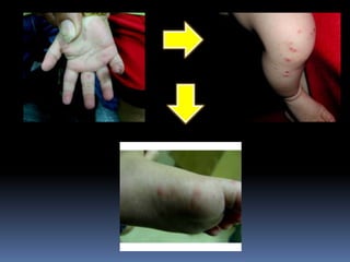 โรคมือ เท้า ปาก