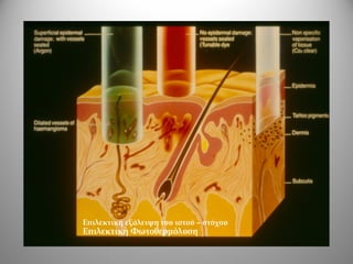 Επιλεκτική εξάλειψη του ιστού – στόχου
Επιλεκτική Φωτοθερμόλυση
 