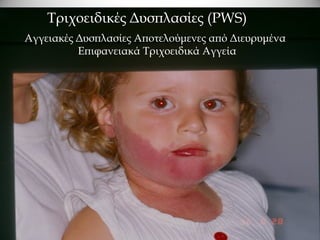 Τριχοειδικές Δυσπλασίες (PWS)
Αγγειακές Δυσπλασίες Αποτελούμενες από Διευρυμένα
          Επιφανειακά Τριχοειδικά Αγγεία
 