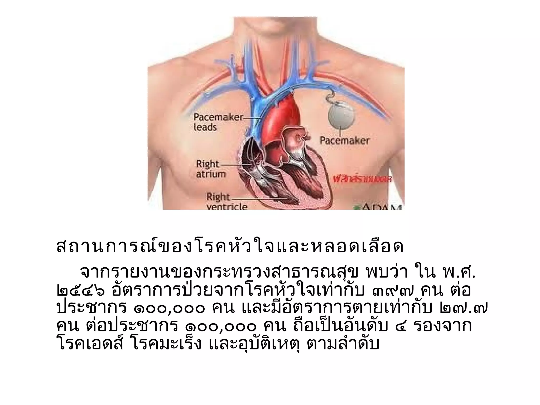 สถำนกำรณ์ข องโรคหัว ใจและหลอดเลือ ด
  จำกรำยงำนของกระทรวงสำธำรณสุข พบว่ำ ใน พ.ศ.
๒๕๔๖ อัตรำกำรป่วยจำกโรคหัวใจเท่ำกับ ๓๙๗ คน ต่อ
ประชำกร ๑๐๐,๐๐๐ คน และมีอัตรำกำรตำยเท่ำกับ ๒๗.๗
คน ต่อประชำกร ๑๐๐,๐๐๐ คน ถือเป็นอันดับ ๔ รองจำก
โรคเอดส์ โรคมะเร็ง และอุบัติเหตุ ตำมลำำดับ
 