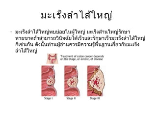 มะเร็ง ลำา ไส้ใ หญ่
• มะเร็งลำาไส้ใหญ่พบบ่อยในผู้ใหญ่ มะเร็งส่านใหญ่รักษา
  หายขาดถ้าสามารถวินิจฉัยได้เร็วและรักษาเร็วมะเร็งลำาไส้ใหญ่
  ก็เช่นกัน ดังนั้นท่านผู้อ่านควรมีความรู้พื้นฐานเกี่ยวกับมะเร็ง
  ลำาไส้ใหญ่
 