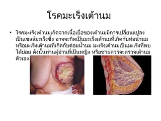 โรคมะเร็งเต้านม
• โรคมะเร็งเต้านมเกิดจากเนื้อเยื่อของเต้านมมีการเปลียนแปลง
                                                       ่
  เป็นเซลล์มะเร็งซึ่ง อาจจะกิดเป็นมะเร็งเต้านมที่เกิดกับท่อนำ้านม
  หรือมะเร็งเต้านมที่เกิดกับต่อมนำ้านม มะเร็งเต้านมเป็นมะเร็งที่พบ
  ได้บ่อย ดังนั้นท่านผู้อ่านที่เป็นหญิง หรือชายควรจะตรวจเต้านม
  ตัวเอง
 