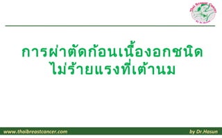 การผ่า ตัด ก้อ นเนื้อ งอกชนิด
         ไม่ร ้า ยแรงที่เ ต้า นม
                               นพ.หะสัน มูห าหมัด
                               วว.ศัล ยศาสตร์ท ั่ว ไป
                               วว.ศัล ยศาสตร์ม ะเร็ง วิท ยา
               ศัล ยแพทย์โ รคมะเร็ง และศัล ยแพทย์เ ต้า นม รพ .พญาไท1




www.thaibreastcancer.com                                               by Dr.Hasun
 