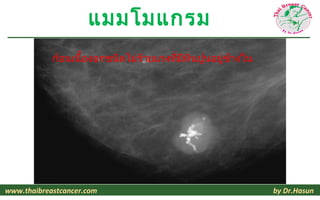 แมมโมแกรม
            ก้อนเนื้องอกชนิดไม่ร้ายแรงที่มีหินปูนอยู่ข้างใน




www.thaibreastcancer.com                                      by Dr.Hasun
 