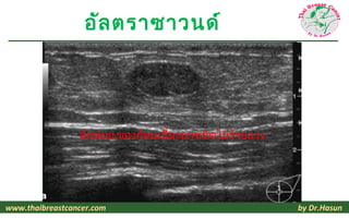 อัล ตราซาวนด์




                 ลักษณะของก้อนเนืองอกชนิดไม่ร้ายแรง
                                 ้




www.thaibreastcancer.com                              by Dr.Hasun
 