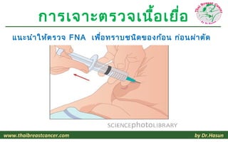 การเจาะตรวจเนื้อ เยื่อ
   แนะนำา ให้ต รวจ FNA เพื่อ ทราบชนิด ของก้อ น ก่อ นผ่า ตัด




www.thaibreastcancer.com                              by Dr.Hasun
 