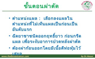 ขัน ตอนผ่า ตัด
                 ้

     • ตำา แหน่ง แผล : เลือ กลงแผลใน
       ตำา แหน่ง ที่ไ ม่เ ห็น แผลเป็น ก่อ นเป็น
       อัน ดับ แรก
     • ฉีด ยาชาชนิด ออกฤทธิย าว ก่อ นกรีด
                             ์
       แผล เพื่อ ระงับ อาการปวดหลัง ผ่า ตัด
     • ต้อ งผ่า ก้อ นออกโดยมีเ นื้อ ดีห ่อ หุ้ม ไว้
         เสมอ
www.thaibreastcancer.com                            by Dr.Hasun
 