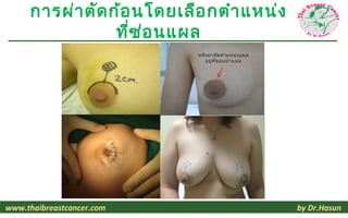 การผ่า ตัด ก้อ นโดยเลือ กตำา แหน่ง
                 ที่ซ ่อ นแผล
                           หลัง ผ่า ตัด ตำา แหน่ง แผล
                              อยู่ท ี่ข อบปานนม
                                               ลบสีดำา




www.thaibreastcancer.com                                 by Dr.Hasun
 