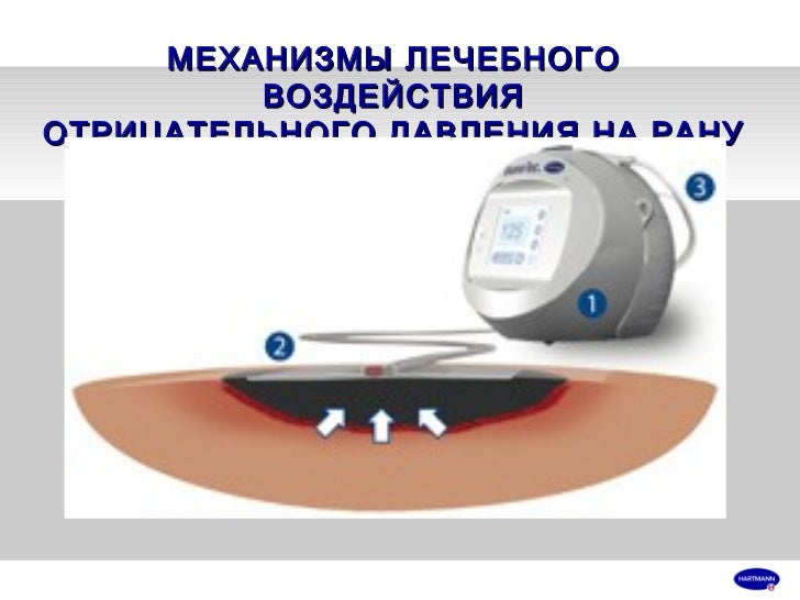 вакуумная терапия ран