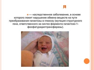я
              я — наследственное заболевание, в основе
   которого лежит нарушение обмена веществ на пути
преобразования галактозы в глюкозу (мутация структурного
  гена, ответственного за синтез фермента галактозо-1-
              фосфатуридилтрансферазы).
 