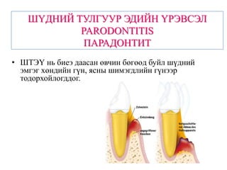 ШҮДНИЙ ТУЛГУУР ЭДИЙН ҮРЭВСЭЛ
            PARODONTITIS
             ПАРАДОНТИТ
• ШТЭҮ нь биеэ даасан өвчин бөгөөд буйл шүдний
  эмгэг хөндийн гүн, ясны шимэгдлийн гүнээр
  тодорхойлогддог.
 