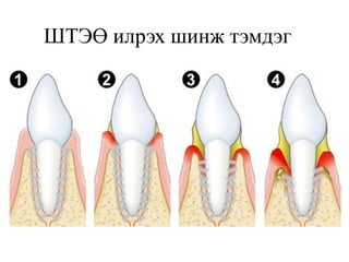 ШТЭӨ илрэх шинж тэмдэг
 
