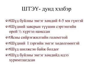 ШТЭҮ- дунд хэлбэр

 Шүд буйлны эмгэг хөндий 4-5 мм гүнтэй
 Шүдний завсрын түүшин сэртэнгийн
орой ½ хүртэл намссан
 Ясны сийрэгжилтийн голомттой
 Шүдний I зэргийн эмгэг хөдөлгөөнтэй
 Шүд шилжсэн байж болдог
 Шүд буйлны эмгэг хөндийд идээ
хуримтлагдсан
 