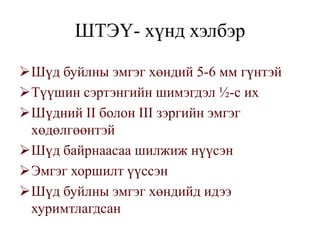 ШТЭҮ- хүнд хэлбэр

Шүд буйлны эмгэг хөндий 5-6 мм гүнтэй
Түүшин сэртэнгийн шимэгдэл ½-с их
Шүдний II болон III зэргийн эмгэг
 хөдөлгөөнтэй
Шүд байрнаасаа шилжиж нүүсэн
Эмгэг хоршилт үүссэн
Шүд буйлны эмгэг хөндийд идээ
 хуримтлагдсан
 