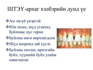 ШТЭҮ-архаг хэлбэрийн дунд үе

Ам эвгүй үнэртэй
Юм хазах, шүд угаахад
 буйлнаас цус гарна
Буйлны өнгө өөрчлөгдсөн
Шүд хооронд зай үүсэх
Буйлны хөхлөг, ирмэгийн
 буйл, түүшийн буйл улайж
 хавагнасан
 