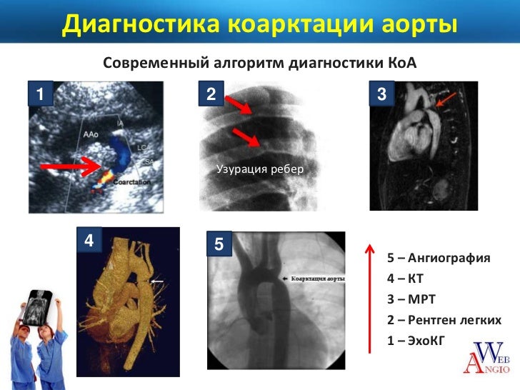 Коарктация аорты