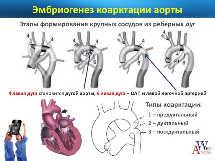 Коарктация аорты