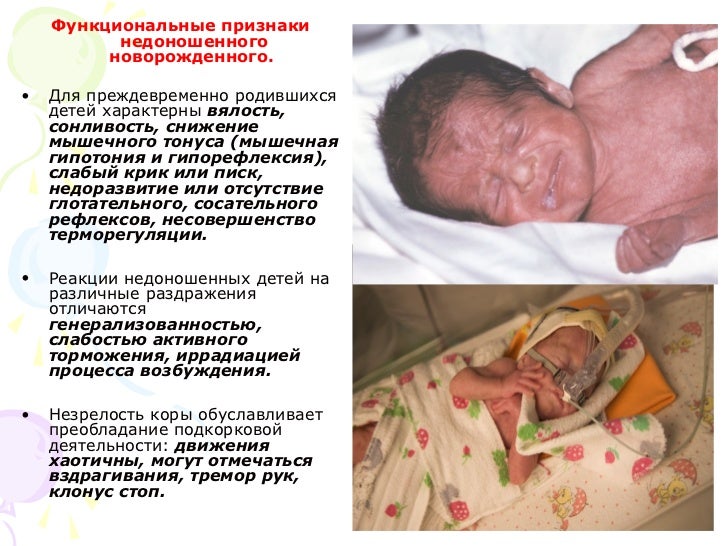 недоношенные новорожденные