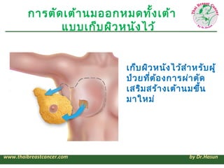 การตัด เต้า นมออกหมดทั้ง เต้า
               แบบเก็บ ผิว หนัง ไว้


                            เก็บ ผิว หนัง ไว้ส ำา หรับ ผู้
                            ป่ว ยทีต ้อ งการผ่า ตัด
                                   ่
                            เสริม สร้า งเต้า นมขึ้น
                            มาใหม่




www.thaibreastcancer.com                         by Dr.Hasun
 