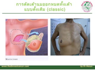การตัด เต้า นมออกหมดทั้ง เต้า
               แบบดั้ง เดิม (classic)




www.thaibreastcancer.com                    by Dr.Hasun
 